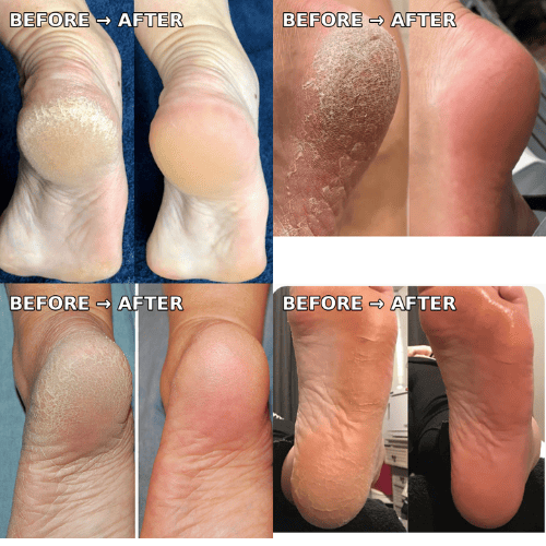 Callus remover Smartuxe