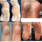 Callus remover Smartuxe