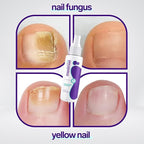 Nail Fungus Remover Spray