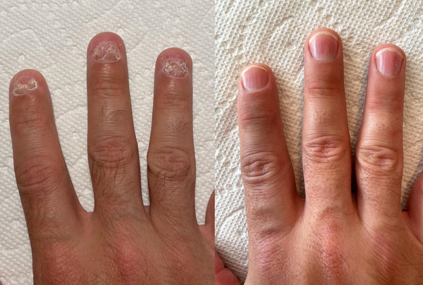 Nail Fungus Remover Spray